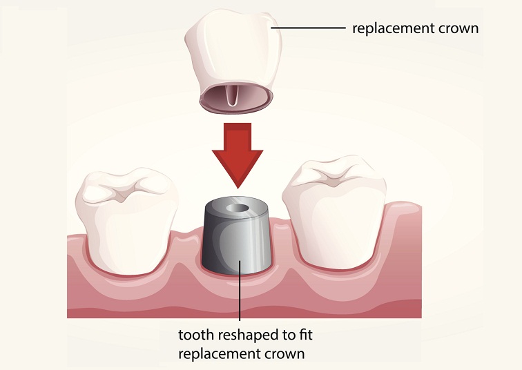 Dental Crowns