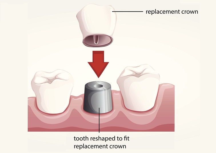Dental Crowns in Wanowrie Pune