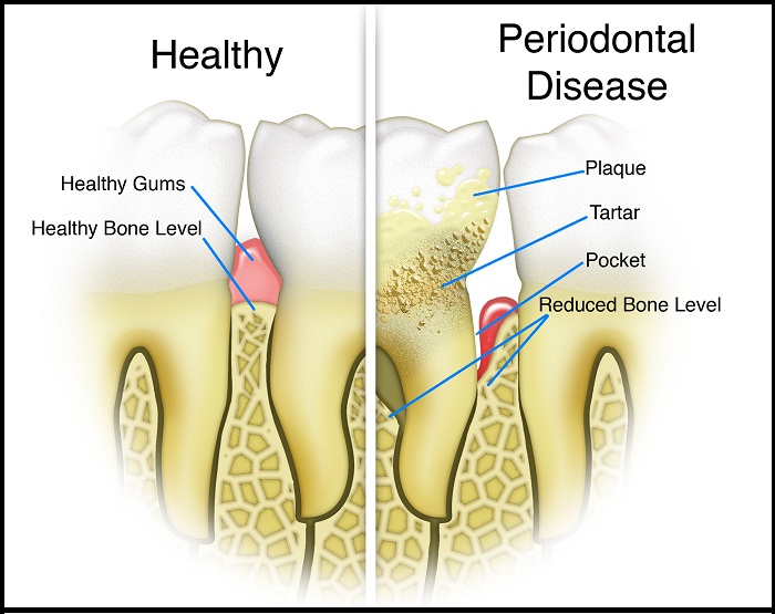 scaling and root planing for gum health