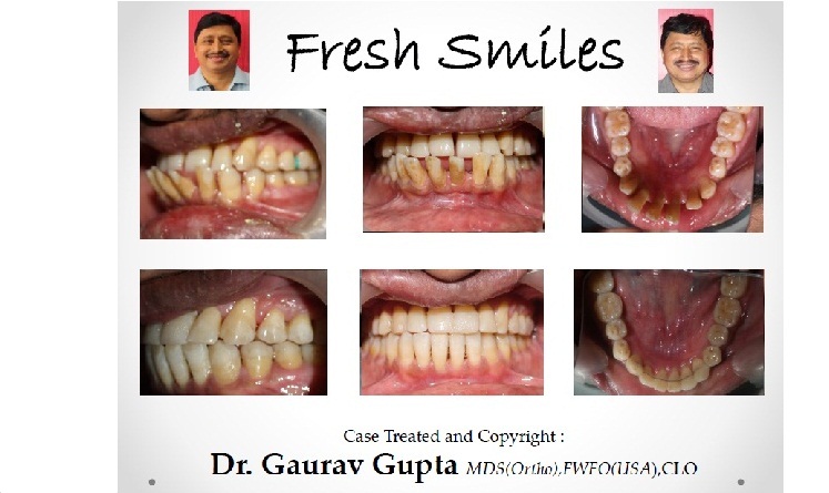 Orthodontic evaluation for adult jaw alignment