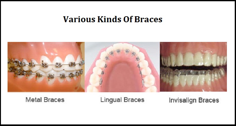 Metal braces on teeth showing traditional orthodontic alignment