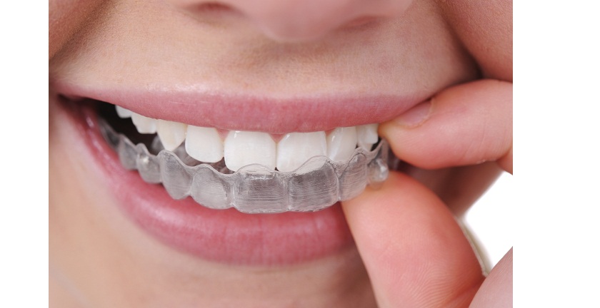 invisalign aligners worn on teeth