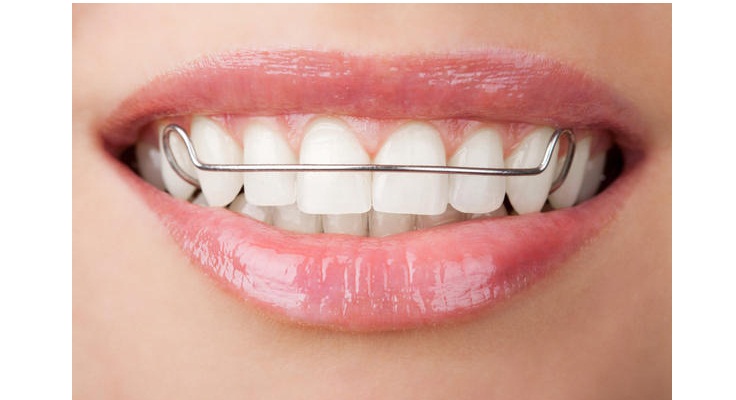 Clear orthodontic retainer for maintaining teeth alignment